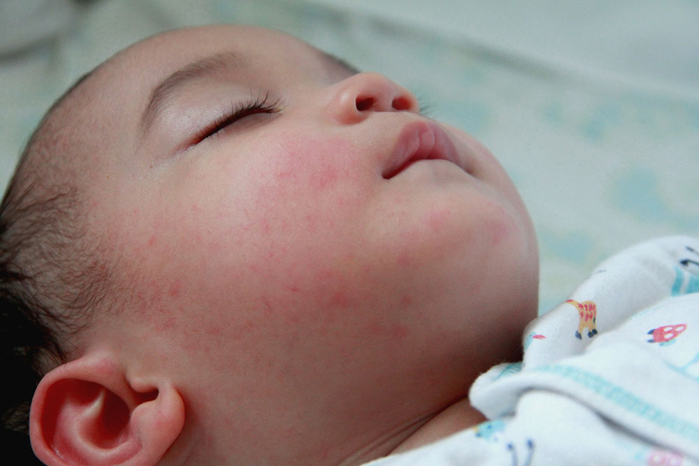 Eczema in babies, kids, and teens – Signs and management